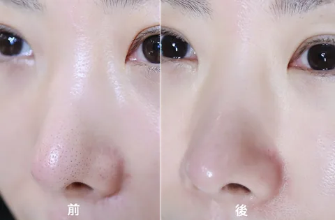 [面膜] 7/1~7/31 困擾黑頭粉刺，大毛孔 如何去除收斂毛孔計畫在樂薇昂 LAVIEN（照片 62）